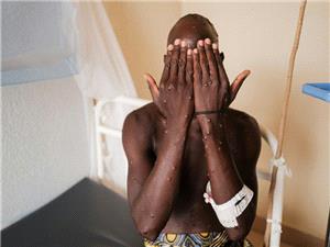 WHO wants $1 bn for world`s worst health crises in 2026